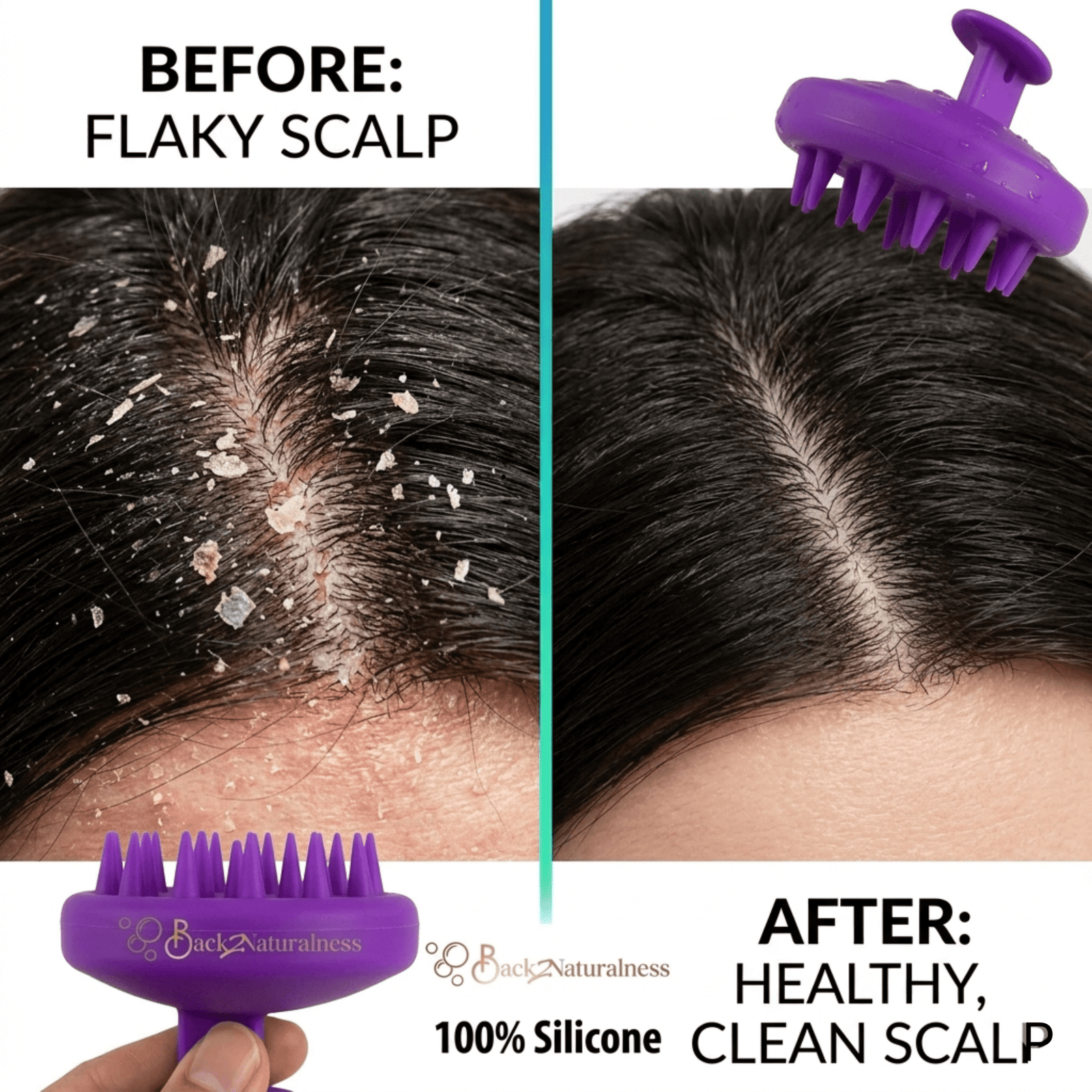 before and after comparison showing dandruff on scalp before using Back2Naturalness silicone scalp massager for hair growth and clear healthy scalp after consistent use